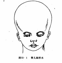 Gyermekek hydrocephalus