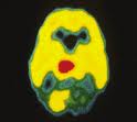 Intracranialis daganatok