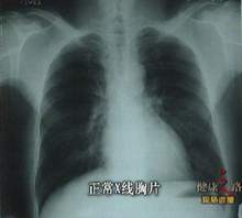 Grafit pneumoconiosis