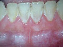 Egyszerű periodontitis