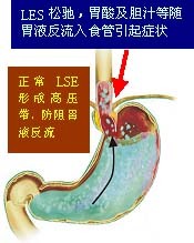 Gastrooesophagealis reflux betegség