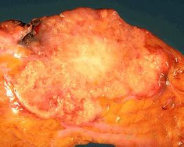 Invazív ductalis carcinoma