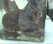 Fekete pneumoconiosis